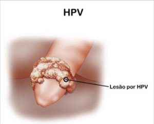 outras-dsts-hpv